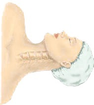 Anterior Cervical Discectomy at Advanced Spine Institute