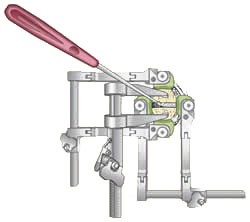 Anterior Cervical Discectomy With Fusion