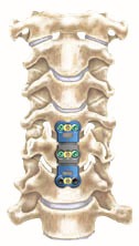 Anterior Cervical Discectomy