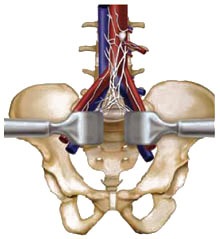 Anterior lumbar interbody fusion (ALIF)