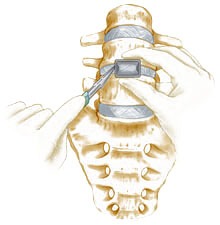 Anterior lumbar interbody fusion