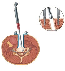 Cervical artificial disc replacement