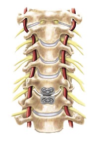 Cervical artificial disc at Advanced Spine Institute