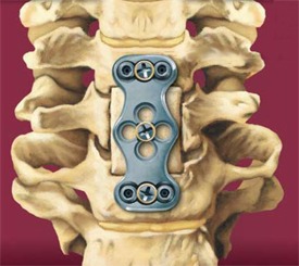 Anterior cervical corpectomy and fusion