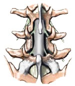 Lumbar Laminectomy Spinal Fusion