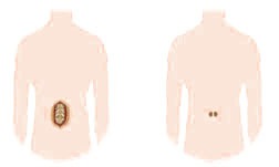 Open VS Minimally Invasive Surgery